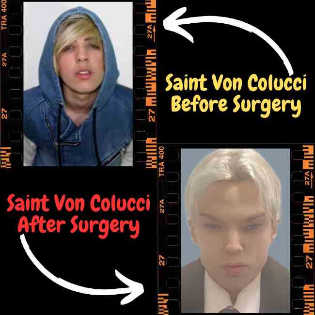 Saint Von Colucci Before and After Surgery